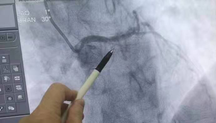 西藏阜康醫(yī)院為急性心肌梗塞患者開辟綠色救治通道